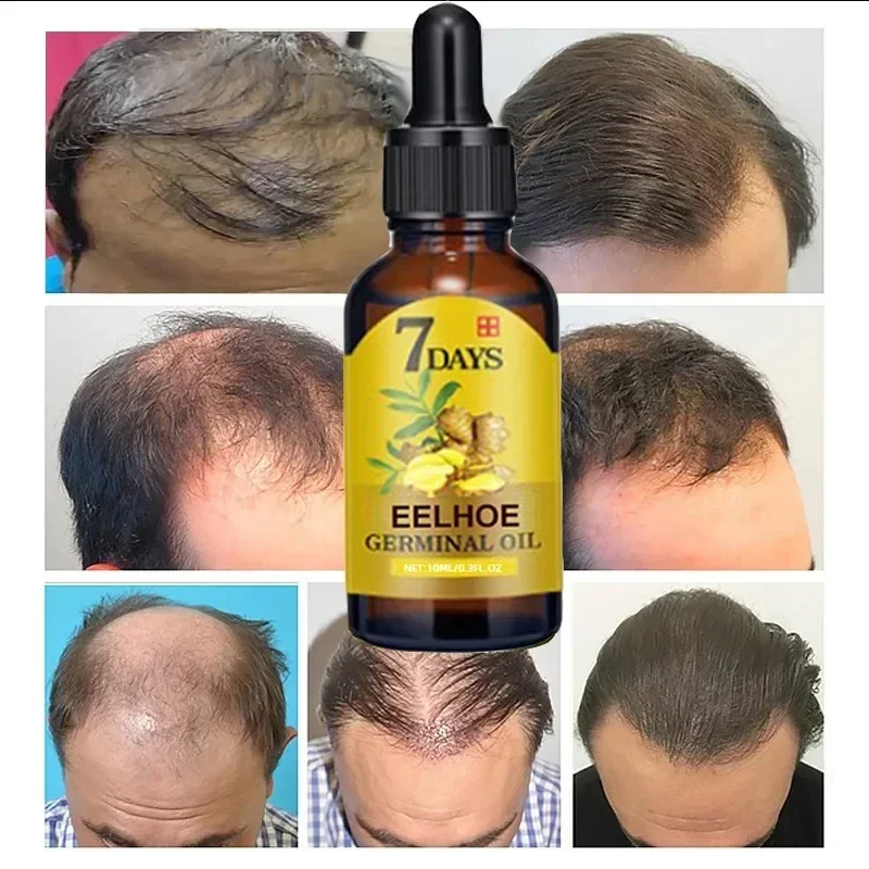 빠른 모발 성장 오일 생강 성장 헤어 트리트먼트, 탈모 - Epidermal Growth Factor 리뷰 및 가격