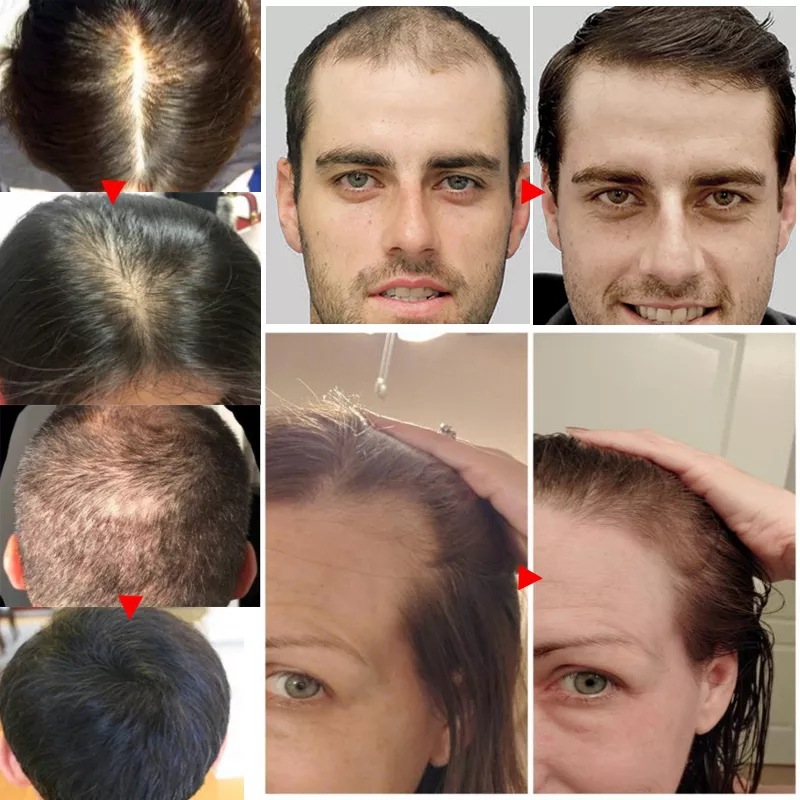 2023 비오틴 빠른 모발 성장 오일 재성장 세럼, 씬 - Epidermal Growth Factor 리뷰 및 가격