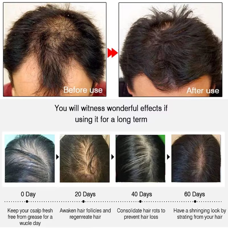 빠른 생강 모발 성장 스프레이, 모발 뿌리 강화, 탈모 - Epidermal Growth Factor 리뷰 및 가격